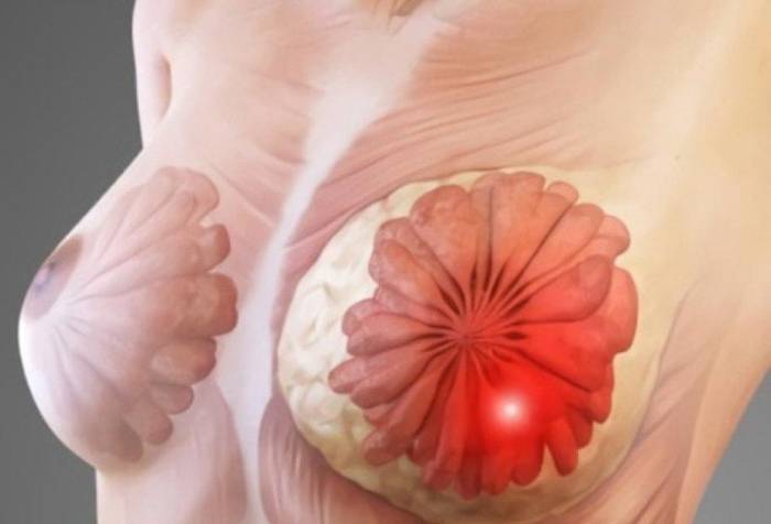 Мастопатия Мастопатия у женщины