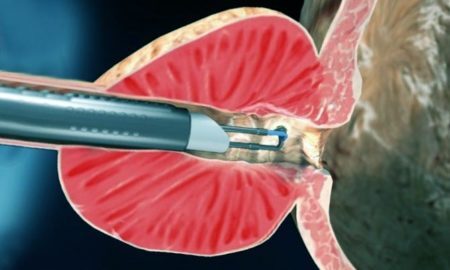 udalenie-adenomy-450x270.jpg udalenie-adenomy-450x270-1